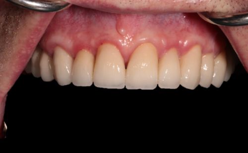 After - Harcourt Dental Clinic