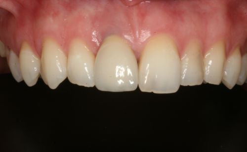 After -Harcourt Dental Clinic