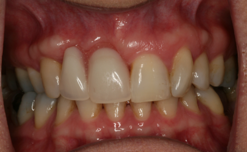 After -Harcourt Dental Clinic