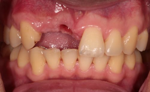 Before - Harcourt Dental Clinic