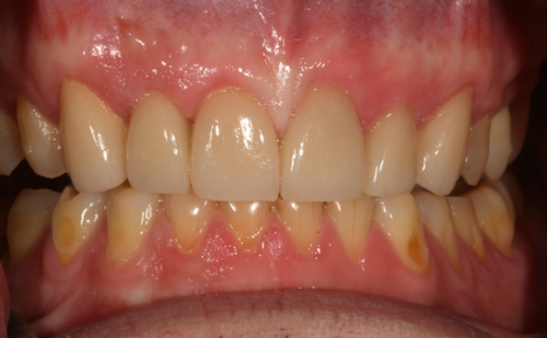 After -Harcourt Dental Clinic