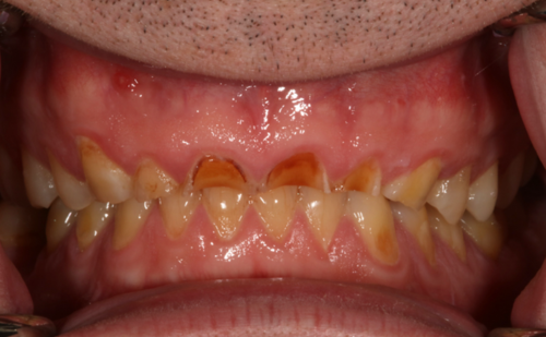 Before - Harcourt Dental Clinic