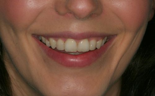 After - Harcourt Dental Clinic