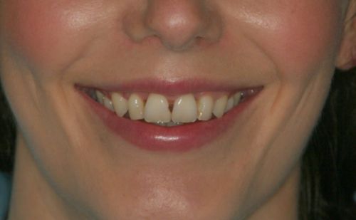 Before - Harcourt Dental Clinic