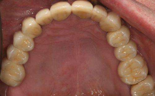 After - Harcourt Dental Clinic