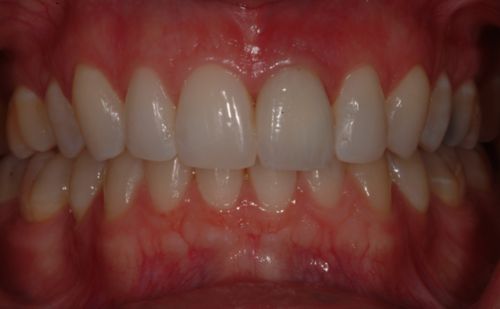 After -Harcourt Dental Clinic