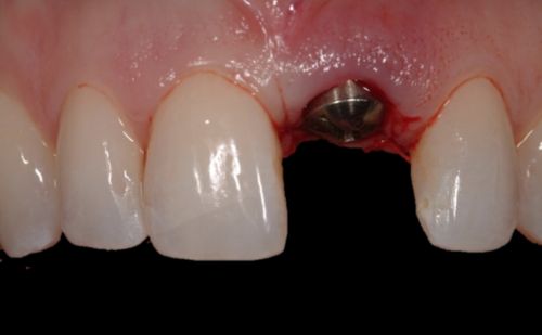 Before - Harcourt Dental Clinic