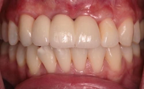 After -Harcourt Dental Clinic