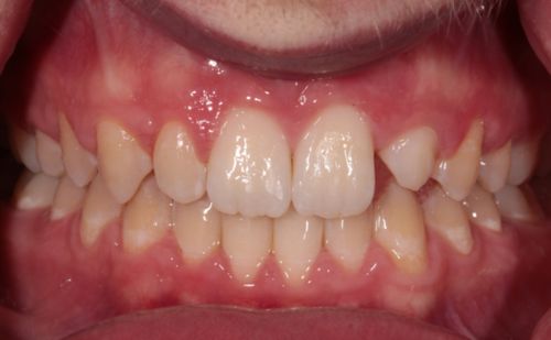 Before - Harcourt Dental Clinic