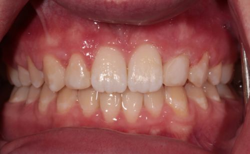 After -Harcourt Dental Clinic