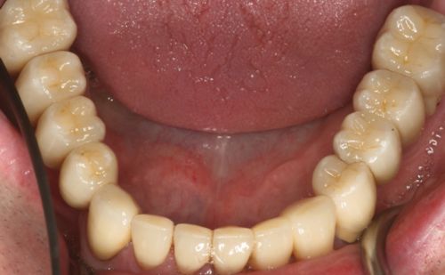 After - Harcourt Dental Clinic