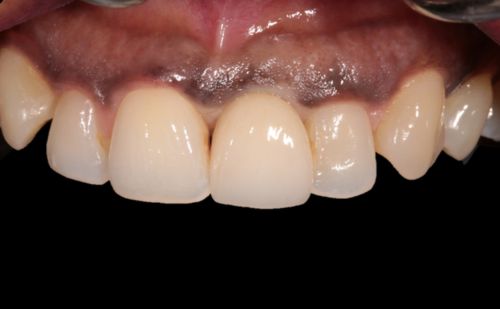 After -Harcourt Dental Clinic