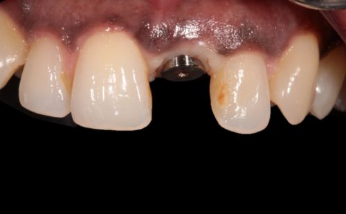 Before - Harcourt Dental Clinic