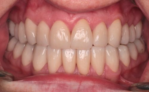 After - Harcourt Dental Clinic