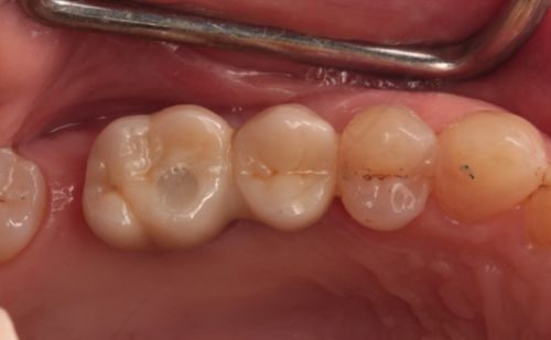 After -Harcourt Dental Clinic