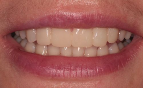 After -Harcourt Dental Clinic