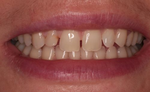 Before - Harcourt Dental Clinic