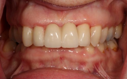 After - Harcourt Dental Clinic