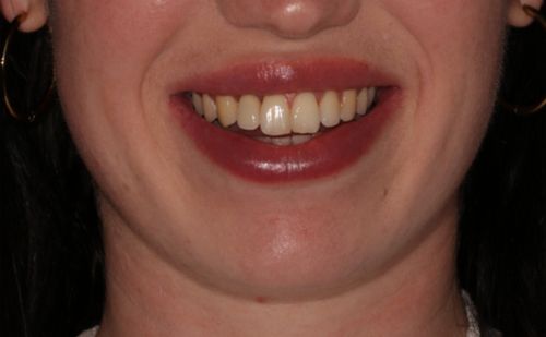 After -Harcourt Dental Clinic