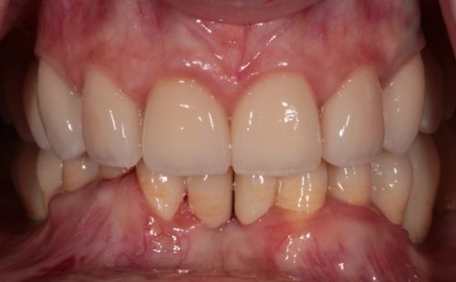 After - Harcourt Dental Clinic