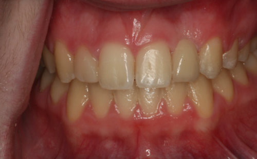 After -Harcourt Dental Clinic