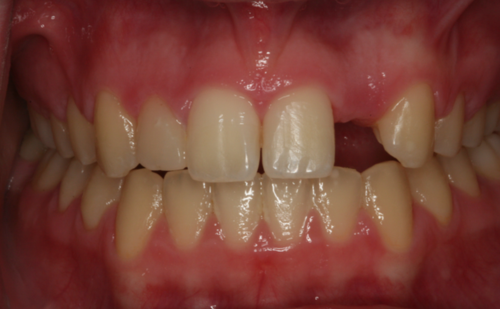 Before - Harcourt Dental Clinic