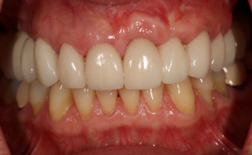 After - Harcourt Dental Clinic