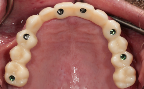 After -Harcourt Dental Clinic