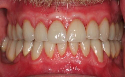 After - Harcourt Dental Clinic