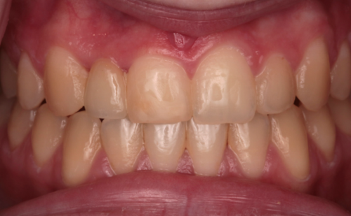 After -Harcourt Dental Clinic