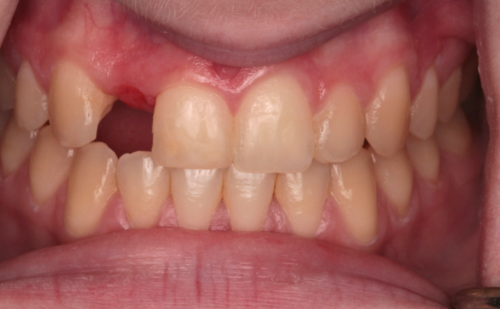 Before - Harcourt Dental Clinic