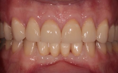 After - Harcourt Dental Clinic