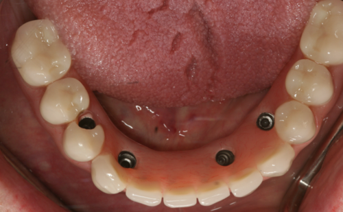 After -Harcourt Dental Clinic