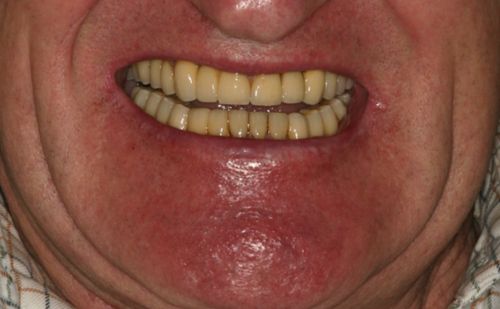 After -Harcourt Dental Clinic