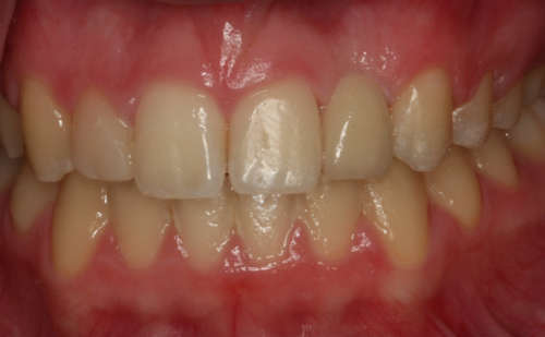 After -Harcourt Dental Clinic