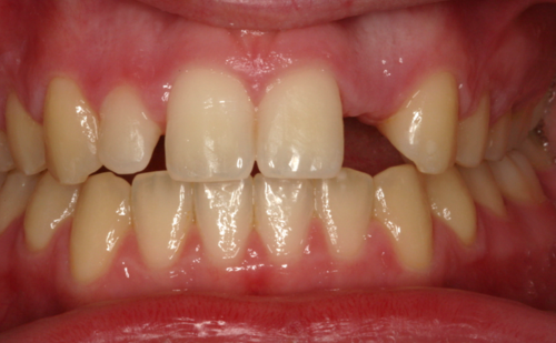 Before - Harcourt Dental Clinic