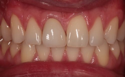 After - Harcourt Dental Clinic