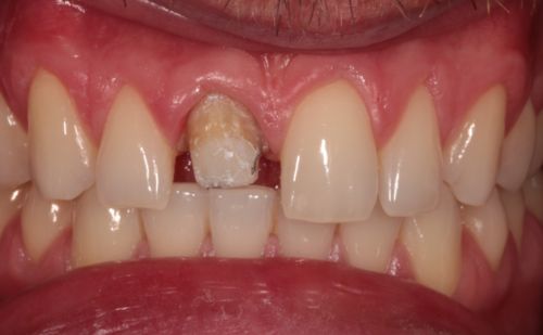 Before - Harcourt Dental Clinic