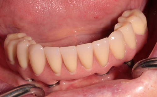 After -Harcourt Dental Clinic