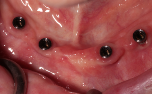 Before - Harcourt Dental Clinic