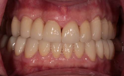 After -Harcourt Dental Clinic