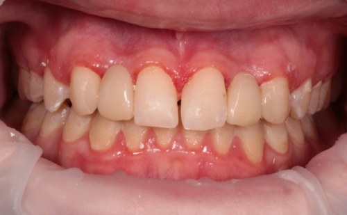 After - Harcourt Dental Clinic