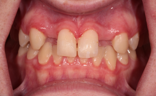 Before - Harcourt Dental Clinic