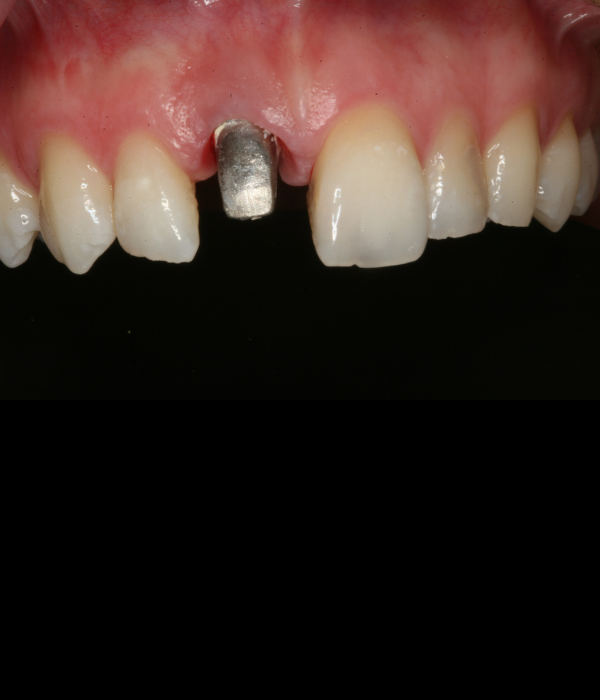 Treatment -  Harcourt Dental Clinic