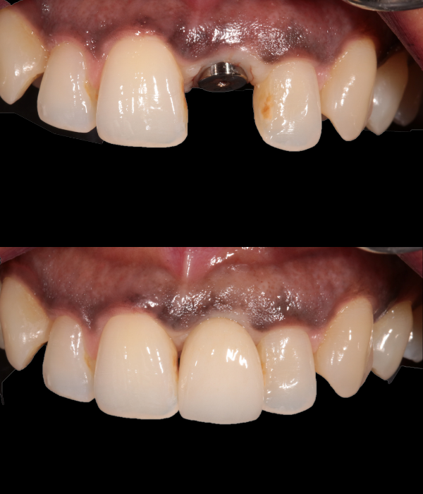 Treatment -  Harcourt Dental Clinic