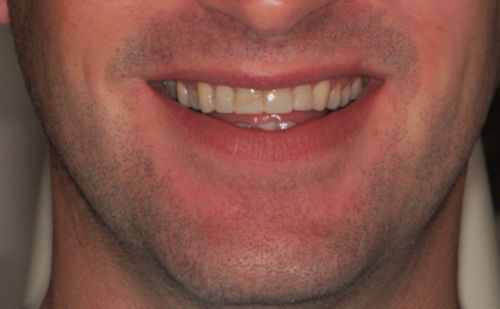 After -Harcourt Dental Clinic