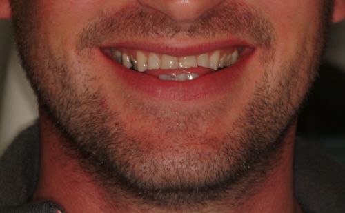 Before - Harcourt Dental Clinic